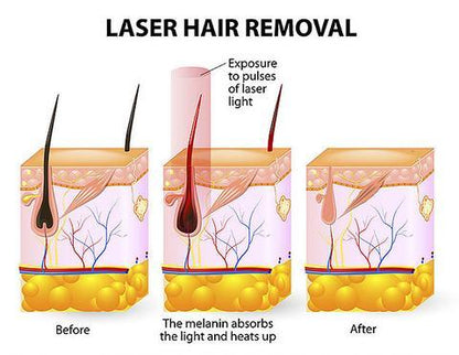 Laser hair removal device