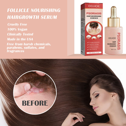 EELHOE Psoriasis Hair Nourishing Essence Deep Cleansing Scalp Anti-Dandruff Anti-Itching Refreshing Thick Hair Care Solution