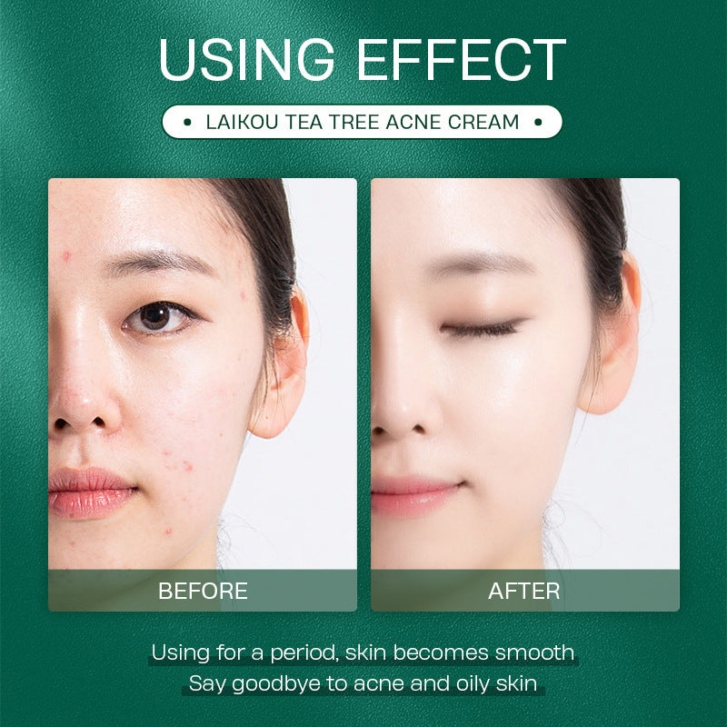 Tea Tree Anti Acne Face Cream 20g Moisturizing Skin Care Product